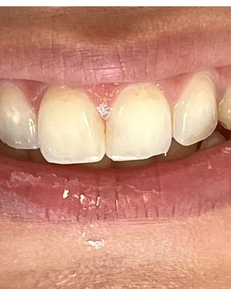 Sorriso de Debora S. antes — Clareamento