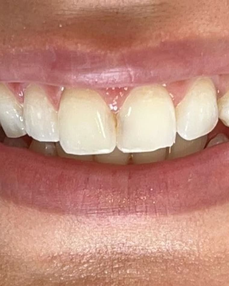 Sorriso de Debora S. depois — Clareamento