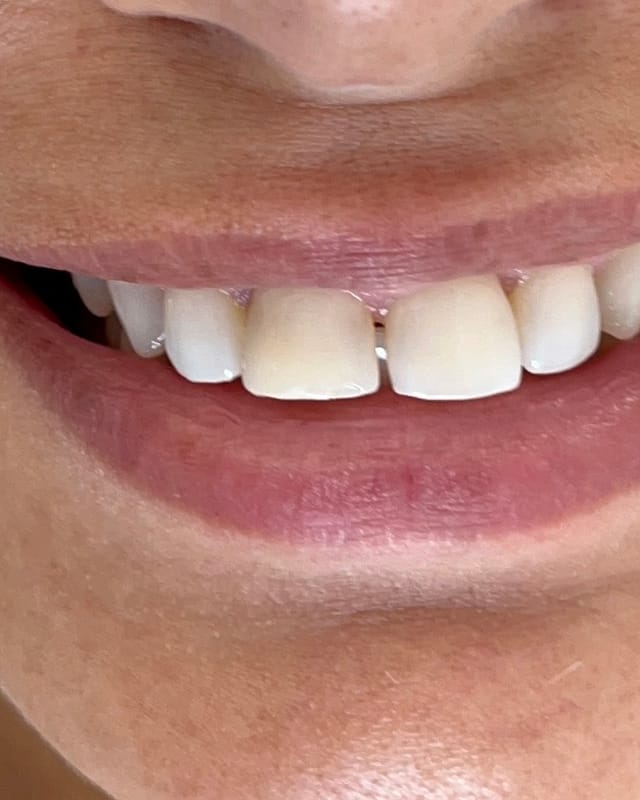 Sorriso de Fernanda S. antes — Facetas em resina