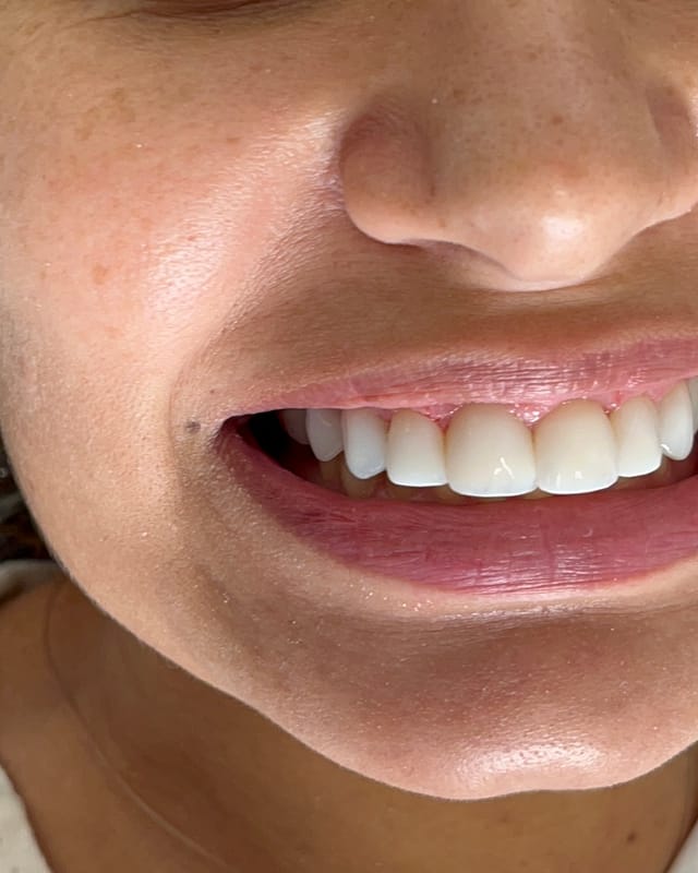 Sorriso de Fernanda S. depois — Facetas em resina