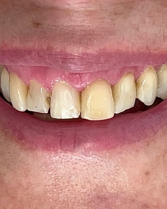 Sorriso de Joyce D. antes — Facetas em resina
