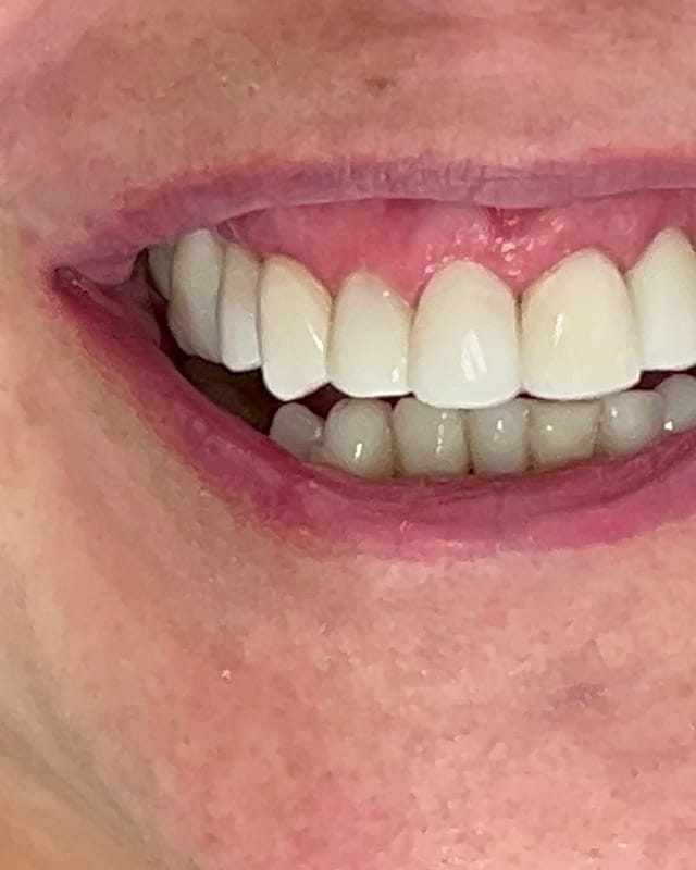 Sorriso de Joyce D. depois — Facetas em resina