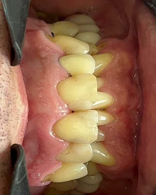 Sorriso de Marcio G. antes — Facetas em resina