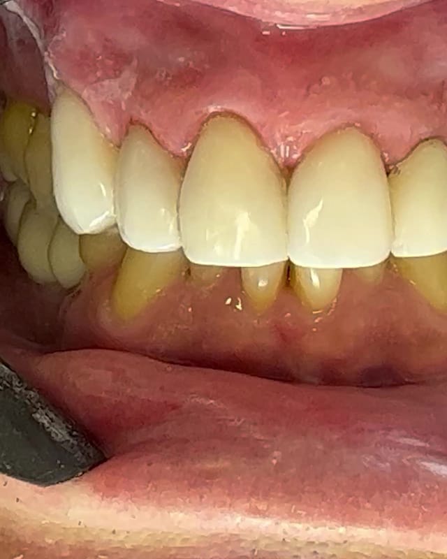 Sorriso de Marcio G. depois — Facetas em resina