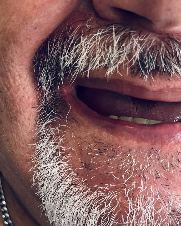 Sorriso de Reabilitação Total antes — Prótese