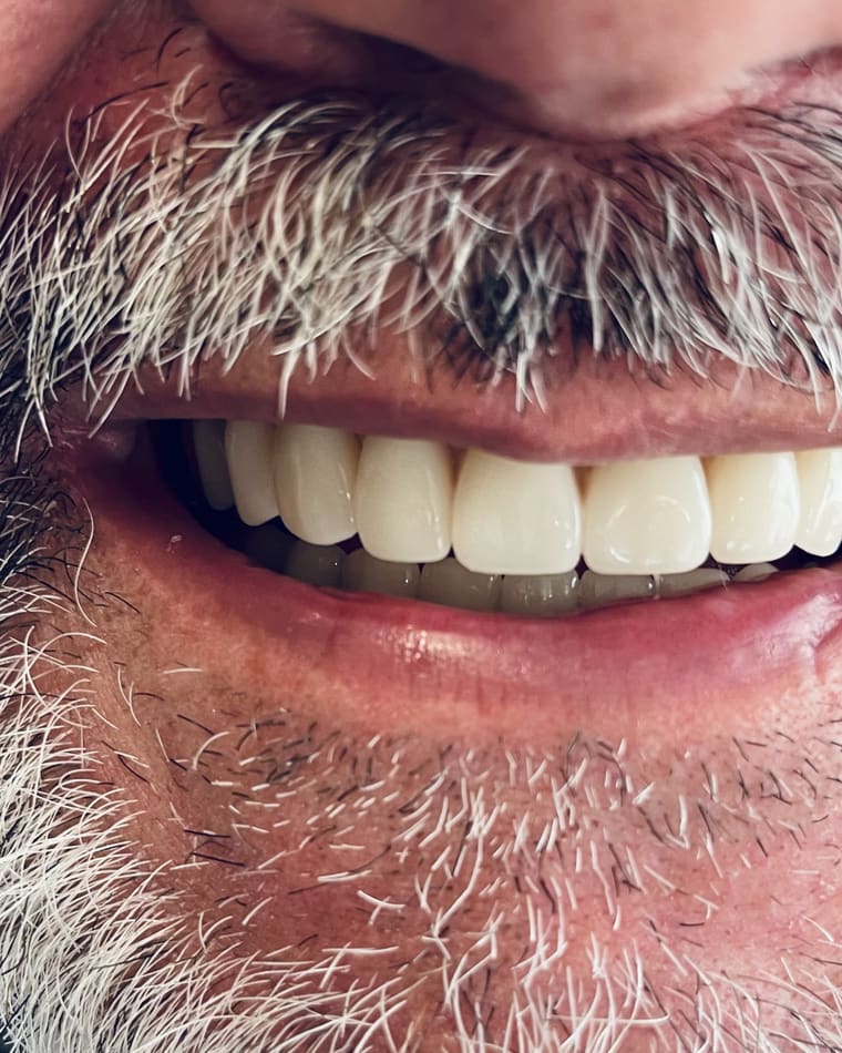 Sorriso de Reabilitação Total depois — Prótese