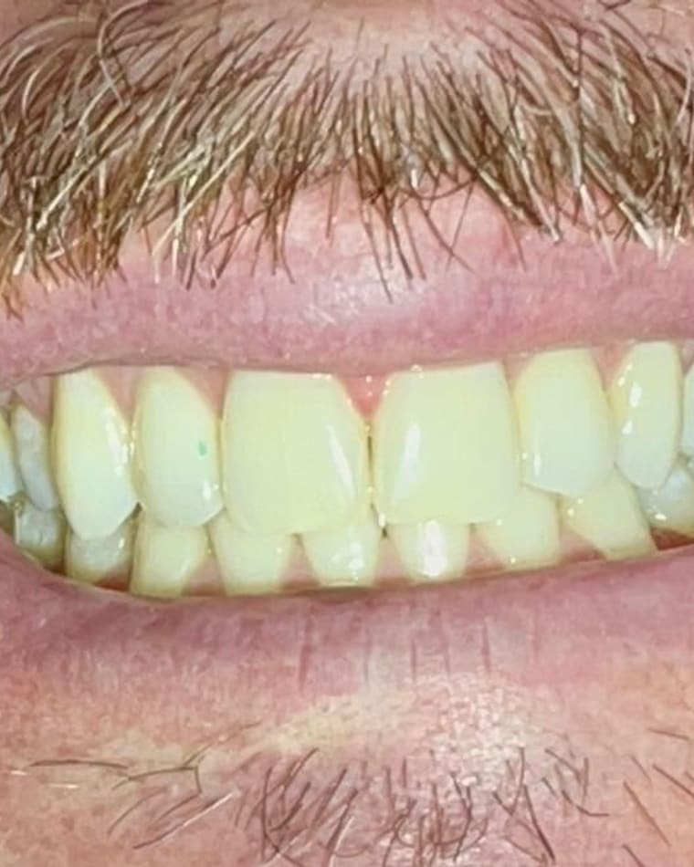 Sorriso de Umberto depois — Clareamento
