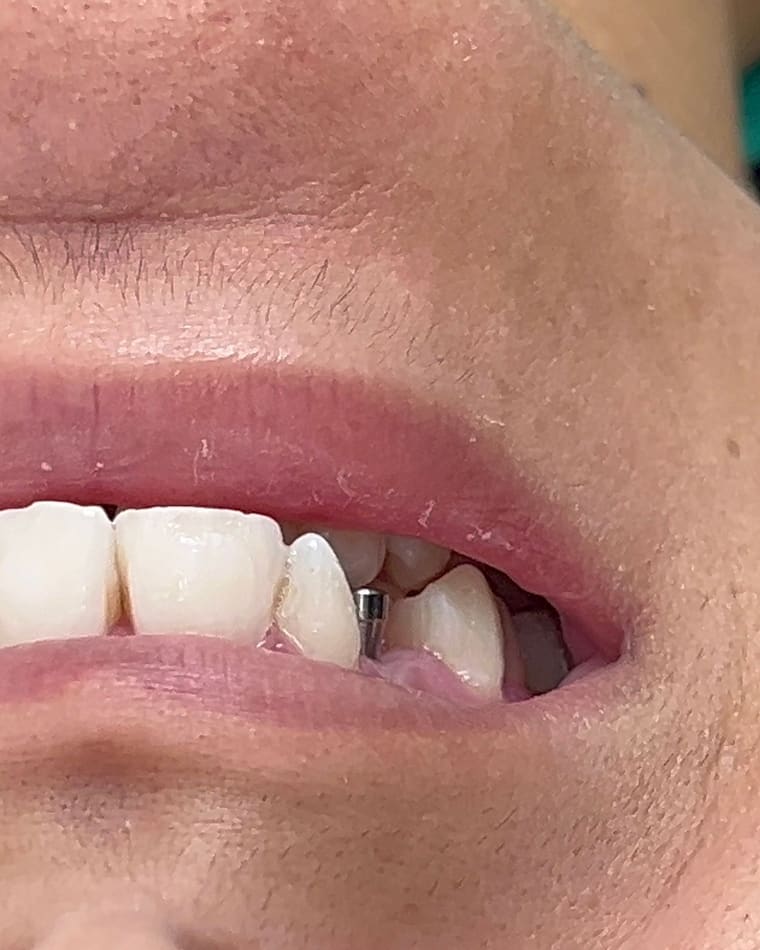 Sorriso de Vitoria C. antes — Facetas em resina