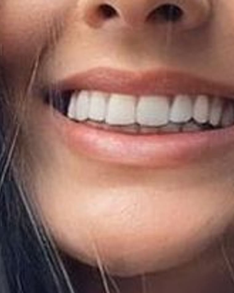 Sorriso de Vitoria C. depois — Facetas em resina